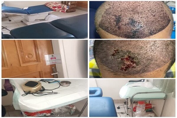 یک مرکز غیرمجاز کاشت مو در خرم‌آباد پلمب شد