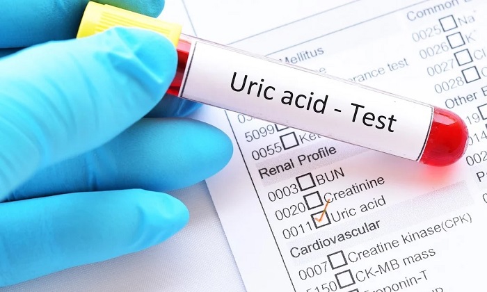 کاهش فوری اسیداوریک