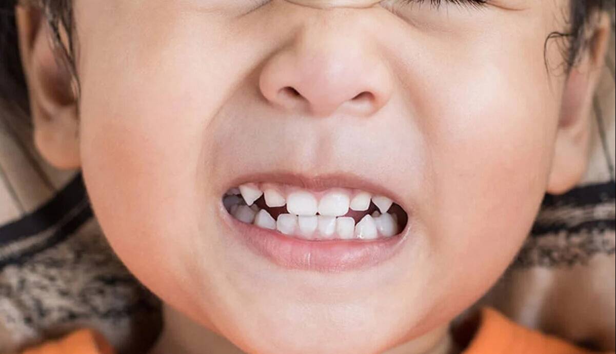 راز دندان قروچه در خواب که هیچکس نمی‌گوید؛ چطور کنترل کنیم؟