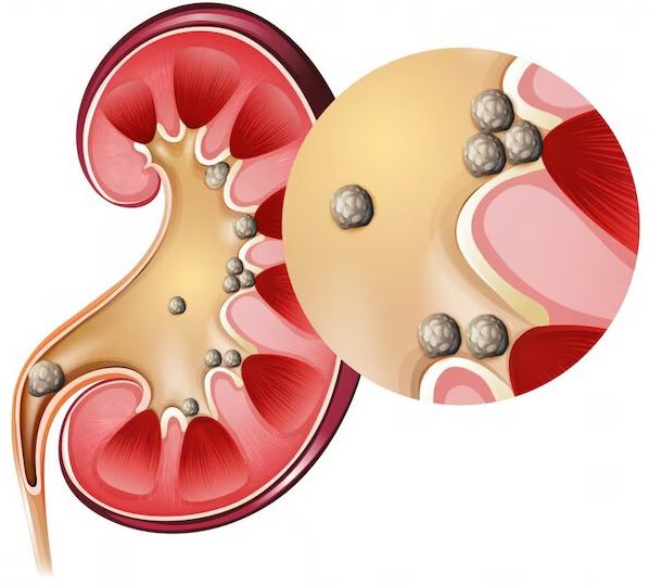 بهترین راهکار برای مبتلا نشدن به سنگ کلیه