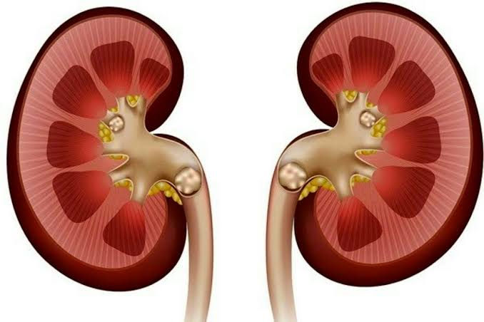 شایع‌ترین دلیل ایجاد سنگ کلیه رسوب املاح در کلیه است