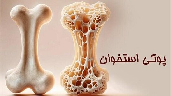 پوکی استخوان در کودکان، واقعیتی فراموش‌شده