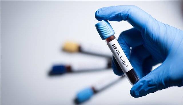 شناسایی سویه جدید «ام پاکس» در انگلیس