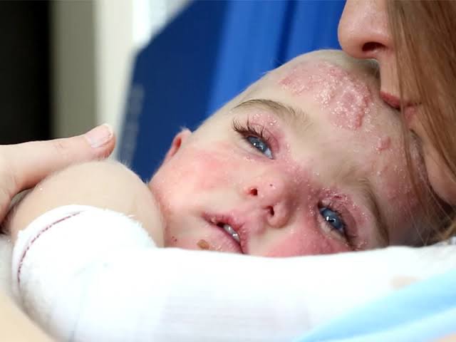 دردناک ترین بیماری پوستی!