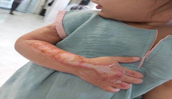 توصیه‌هایی برای پیشگیری از سوختگی