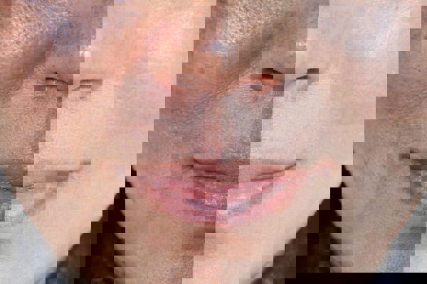 راهی برای درمان تیرگی پوست