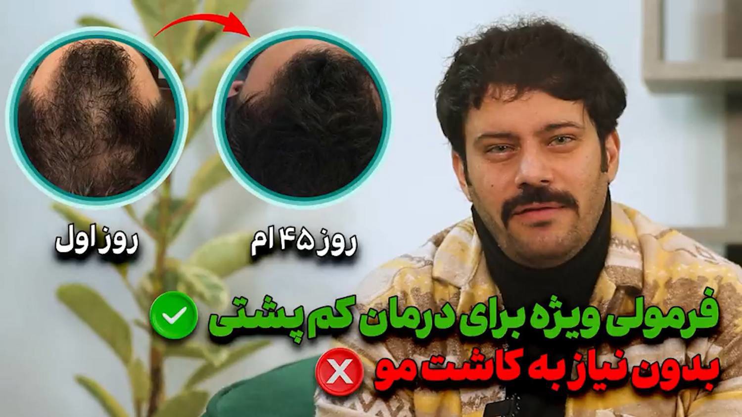 جنجالی‌ترین کشف روز! یکی از موثرترین راه‌های کمک به رویش مجدد مو، بدون کاشت!!!