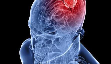 چه کسانی بیشتر در معرض خطر تومورهای مغزی هستند