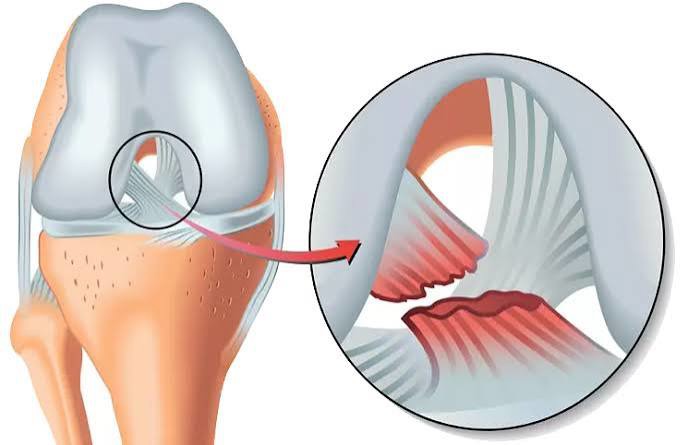 علت پارگی رباط صلیبی چیست؟