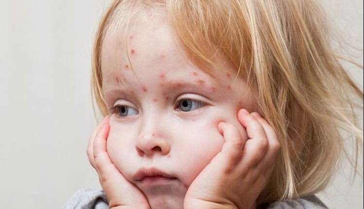 بازگشت سرخک؛ چه کسانی بیشتر در معرض خطرند؟