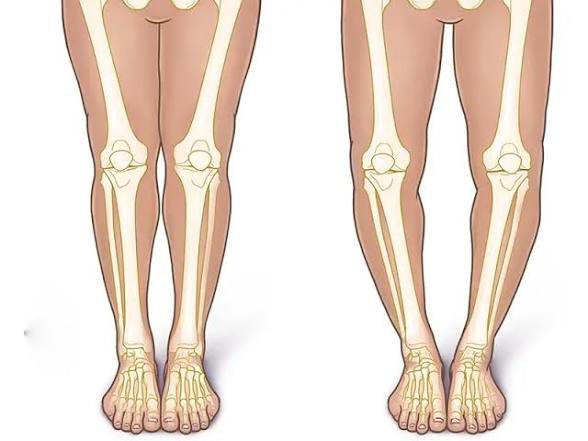 آیا زانوی پرانتزی، نیاز به جراحی دارد؟