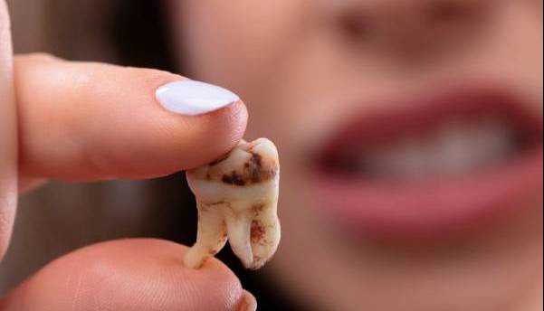 چرا عفونت دندان را نباید دست‌کم گرفت؟