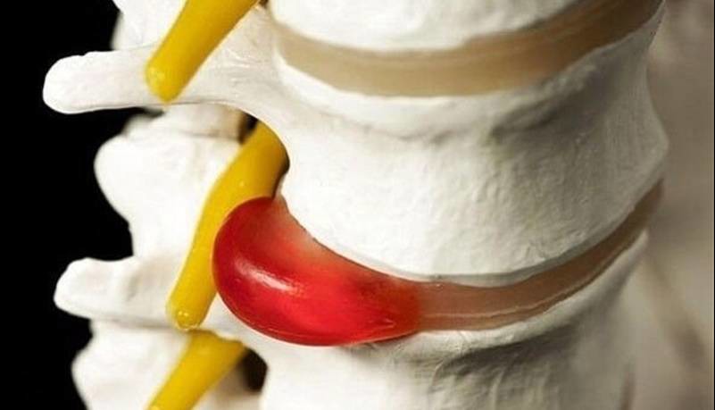 دیسک کمر همیشه به جراحی ختم نمی‌شود